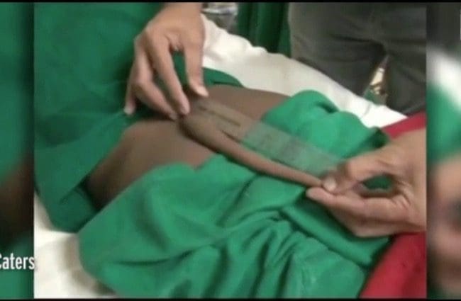 Inde : Arshid, 13 ans, se fait enlever une queue de 18 cm dans le dos (Vidéo)