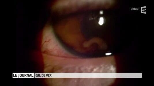 Un adolescent et son oeil de ver !