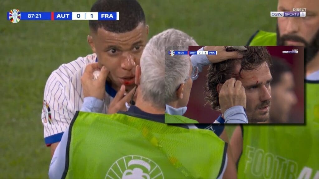 MBAPPE NEZ FRANCE AUTRICHE