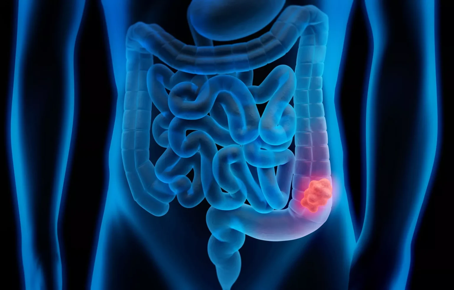 cancerintestin
