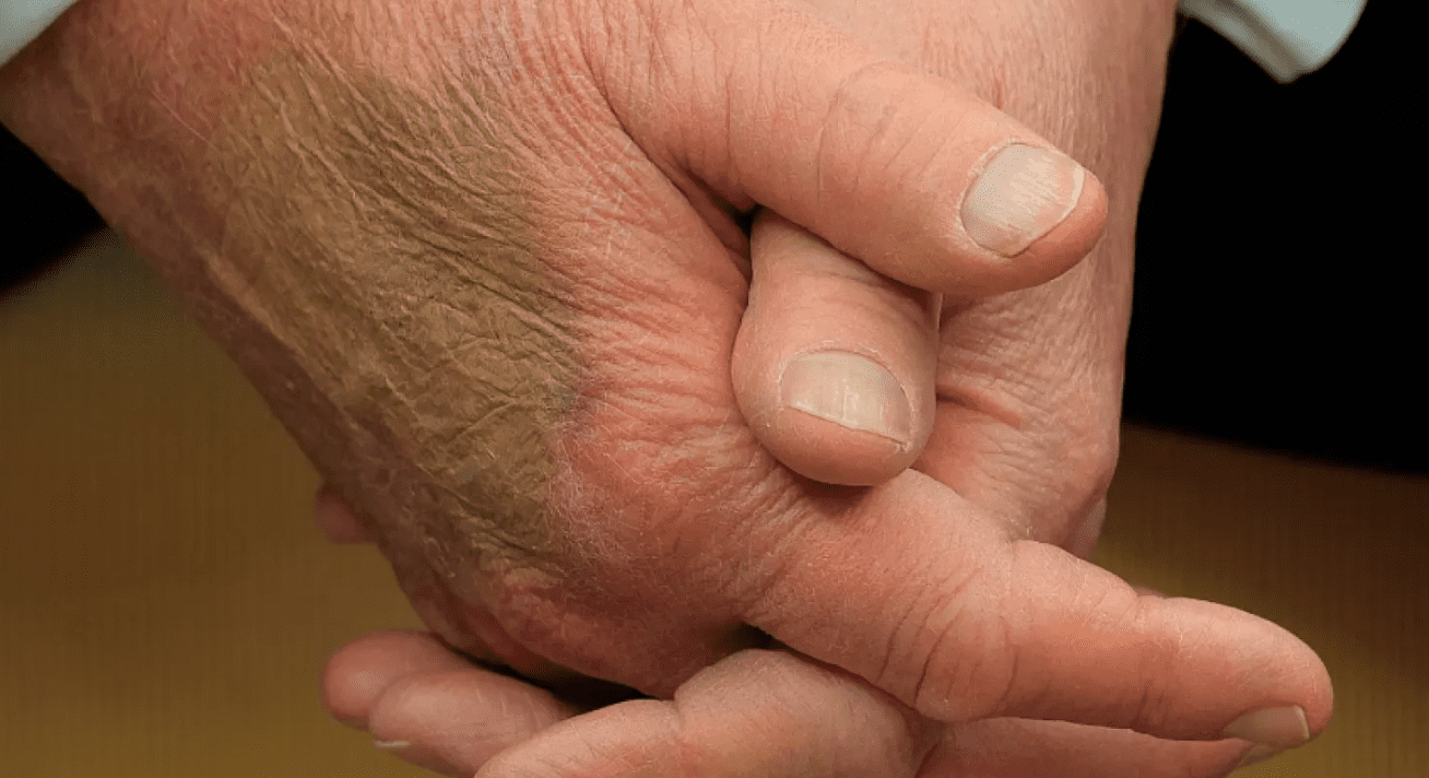 La Maison-Blanche dissipe le mystère autour de l'ecchymose apparue sur la main de Trump