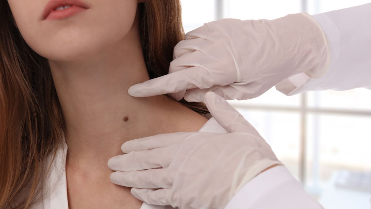 SANTÉ - Comment reconnaître un grain de beauté à risque de devenir cancéreux ?
