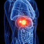 À 82 %... Un outil d’intelligence artificielle prédit la récidive du cancer du foie