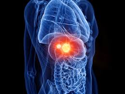 SANTÉ - Un outil d’intelligence artificielle prédit la récidive du cancer du foie