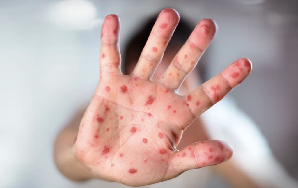 La France en alerte face à une recrudescence de la rougeole