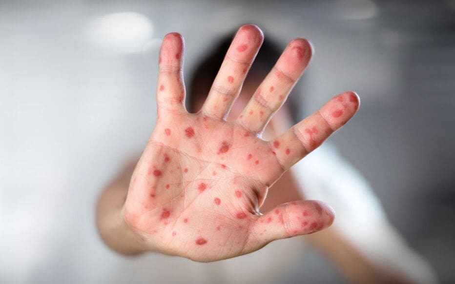 Alerte à la rougeole : forte hausse des cas en France