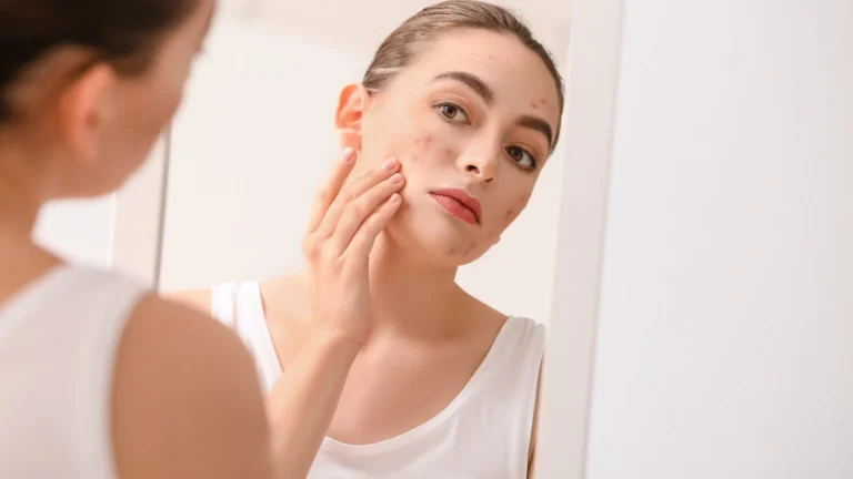 SANTÉ - Le nigelle et le vinaigre: un remède naturel contre l'acné