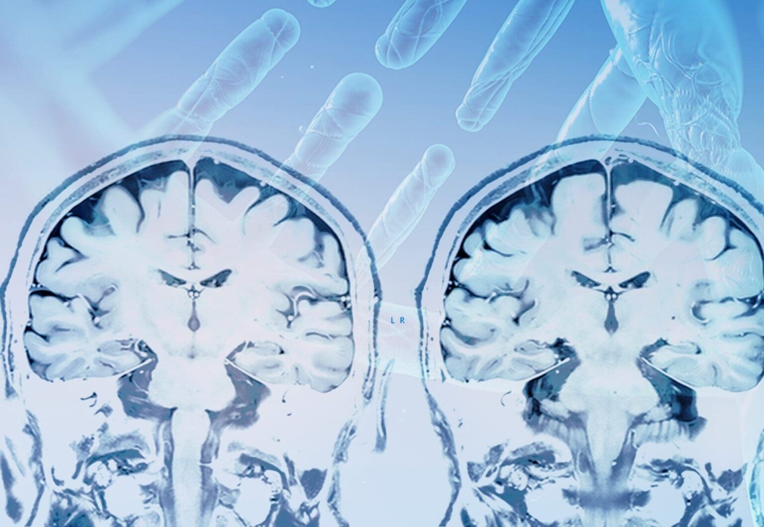 SANTÉ - La maladie de parkinson pourrait résulter d'une mutation d'une protéine cérébrale