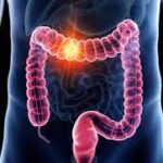 Cancer colorectal : une campagne choc pour inciter au dépistage !