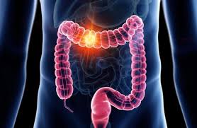 Cancer colorectal : une campagne choc pour inciter au dépistage !