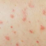 Rougeole en Isère : vaccination d'urgence après un cluster dans la Bièvre