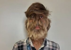 Insolite – Un adolescent indien décroche le record du monde du visage le plus poilu
