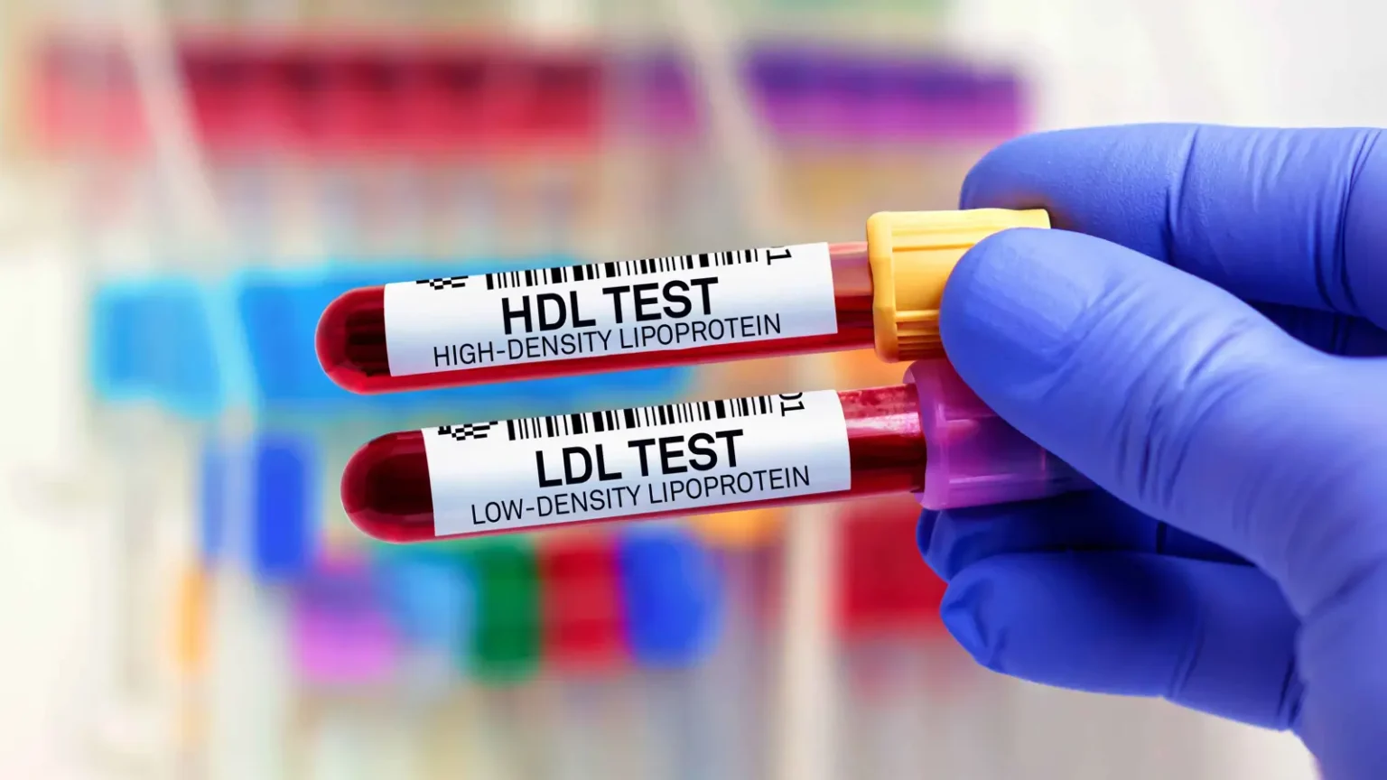 Informations importantes à connaître sur le cholestérol