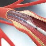 SANTÉ - L'obstruction des artères du cou ne nécessite pas toujours une chirurgie, une étude le révèle