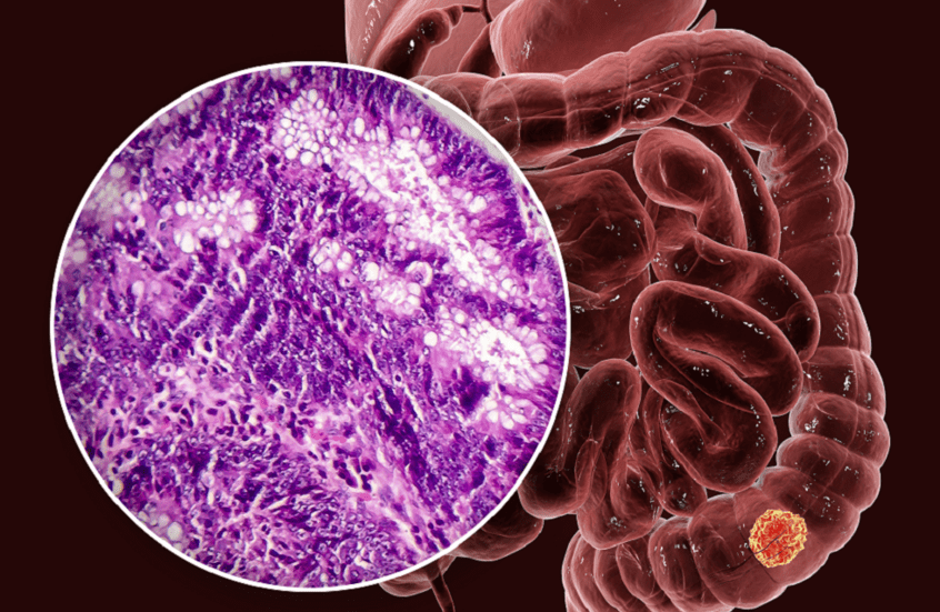 SANTÉ - La cause cachée derrière la recrudescence du cancer colorectal chez les jeunes 