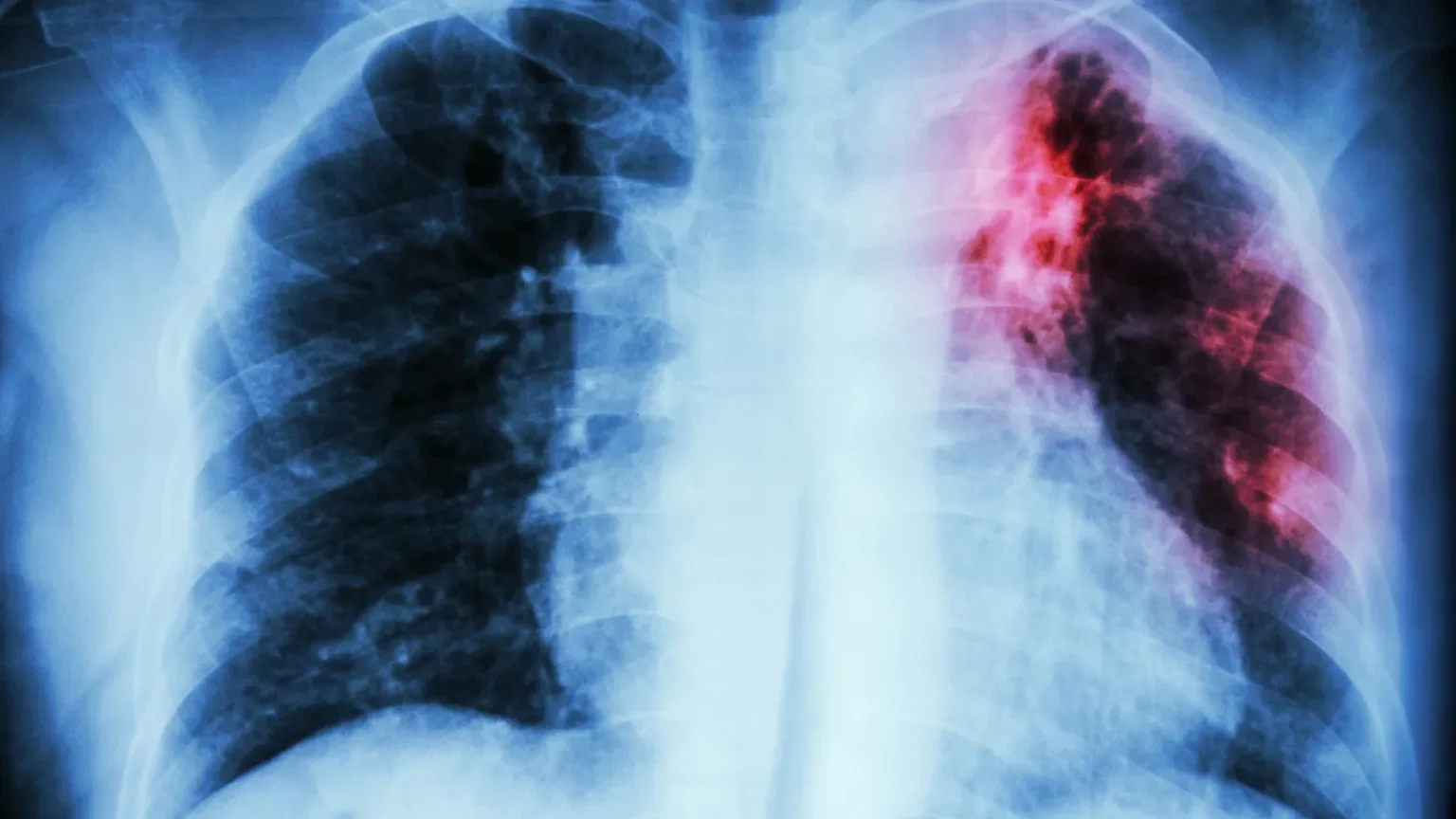 Tuberculose : le Royaume-Uni en alerte. Et la France ?
