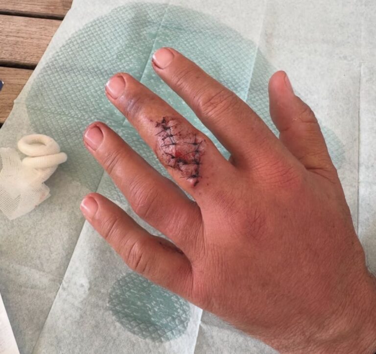 Benjamin Castaldi publie une photo de son doigt après avoir été blessé par son hélicoptère miniature