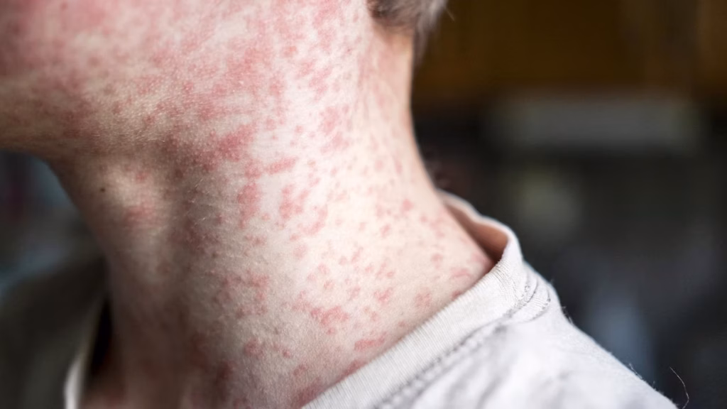 Plus de 900 cas de rougeole recensés aux États-Unis : 10 États en situation d’épidémie