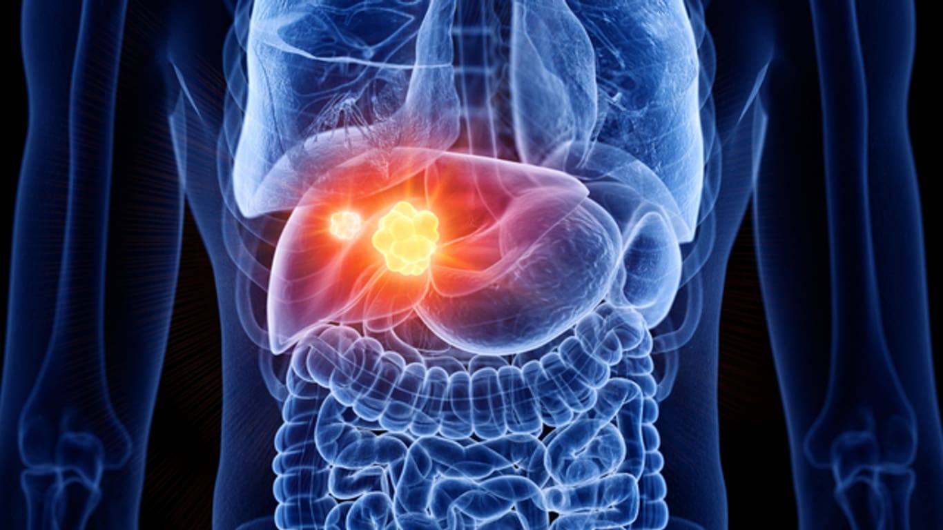 Cancer du foie : une bombe sanitaire évitable mais en pleine progression
