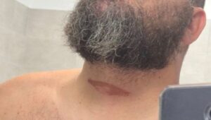 Haut-Rhin : un vététiste échappe de peu à la mort à cause d’un fil tendu en travers d’un sentier