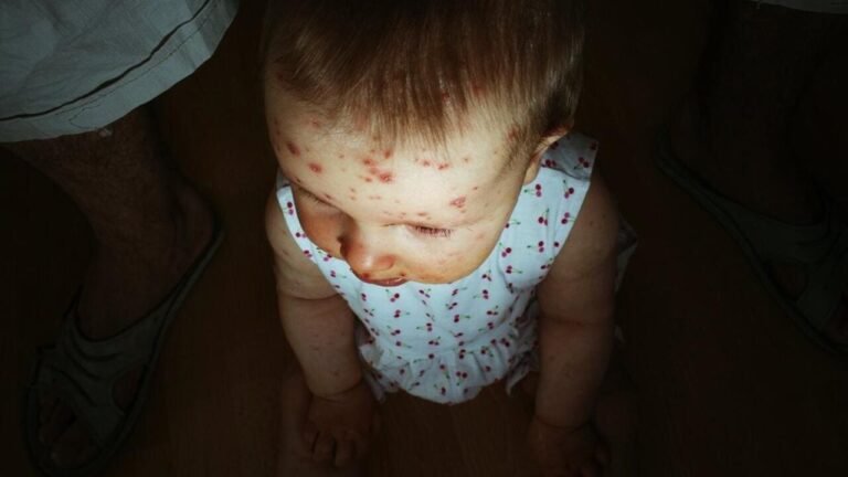 Morbihan : Anaïs, 14 mois, face à une maladie rare qui ne touche que trois enfants par an en France @ gagilas