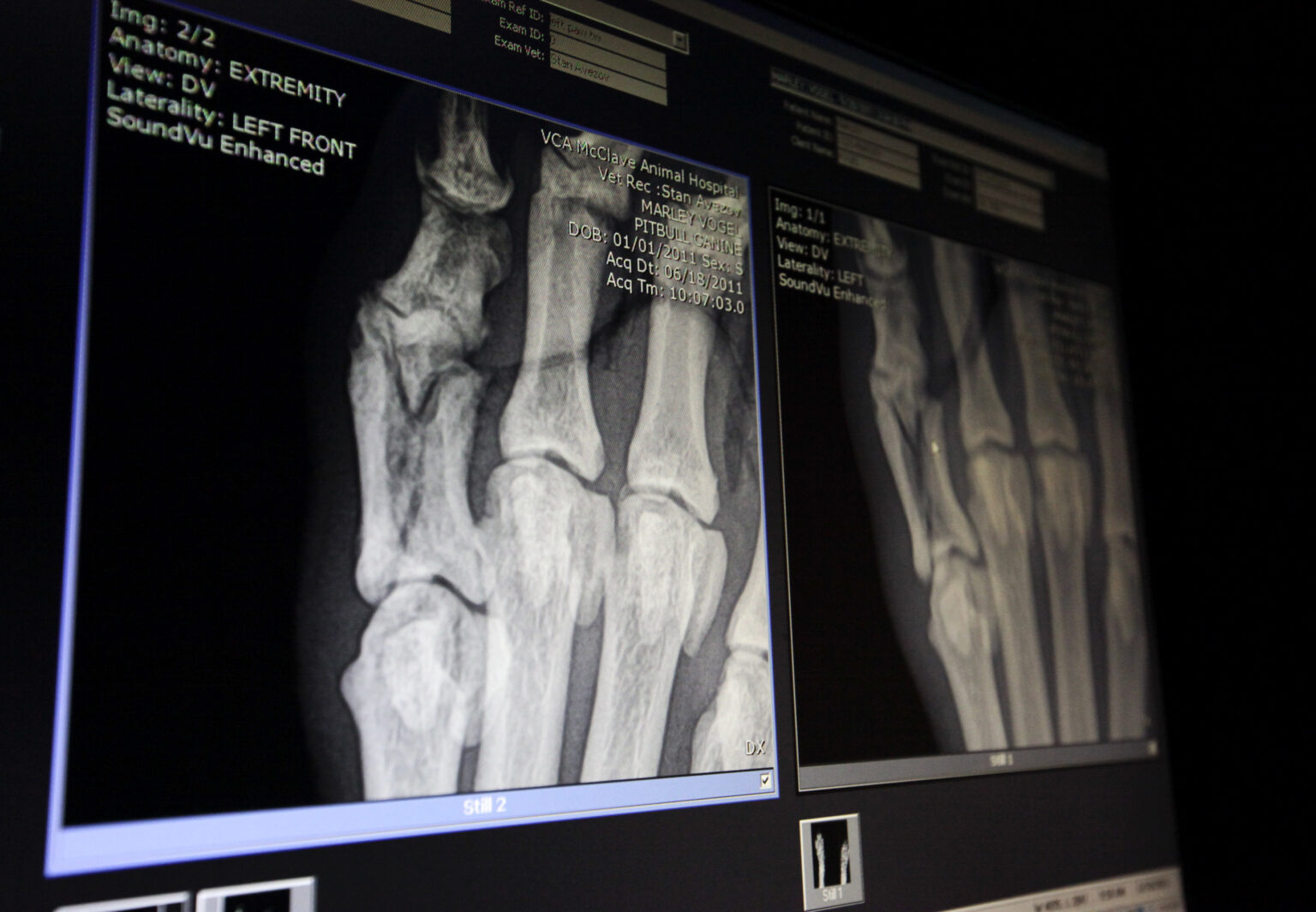 SANTÉ - Des chercheurs chinois affirment avoir inventé une colle pour les os qui répare les fractures en 3 minutes. (AP/Richard Vogel)