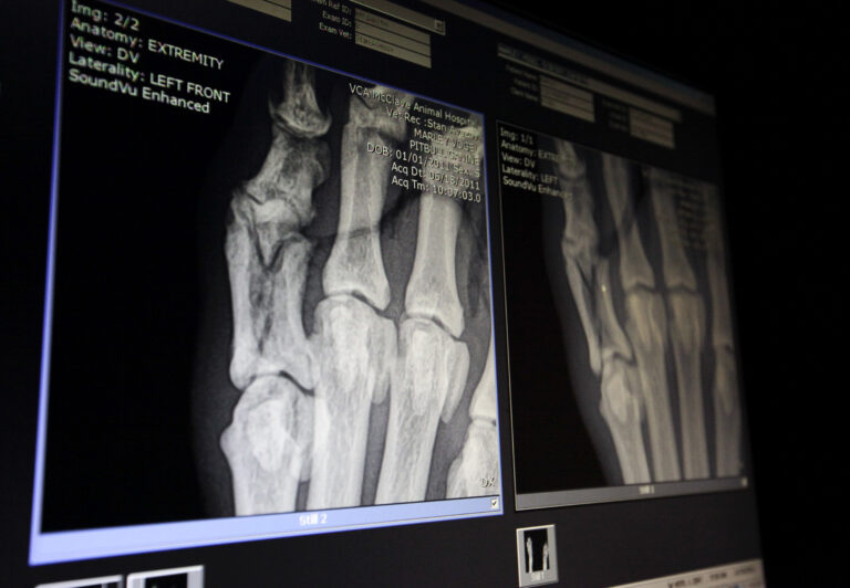 SANTÉ - Des chercheurs chinois affirment avoir inventé une colle pour les os qui répare les fractures en 3 minutes