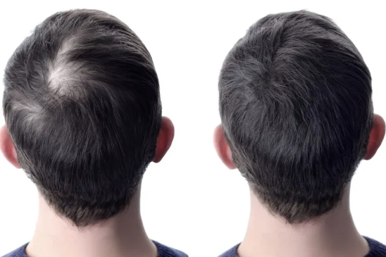 Anti-calvitie - un encadrement renforcé des médicaments face aux risques @omicron