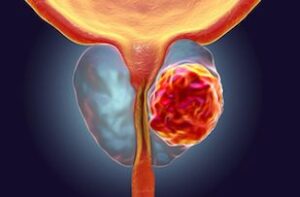 Cancer de la prostate - une combinaison de médicaments réduit la mortalité de 40 %