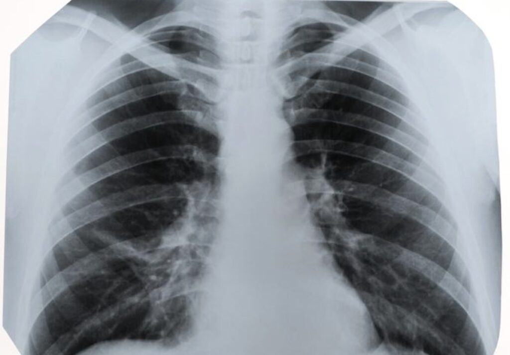 Cancer du poumon chez les femmes : une hausse fulgurante qui dépasse désormais le cancer du sein