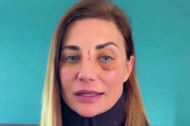 VIDÉO - Ariane Brodier brise le silence après son agression: "Mon nez a été fracturé, j'ai une entorse cervicale."