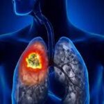Cancer du poumon chez les femmes, une progression silencieuse qui inquiète les médecins