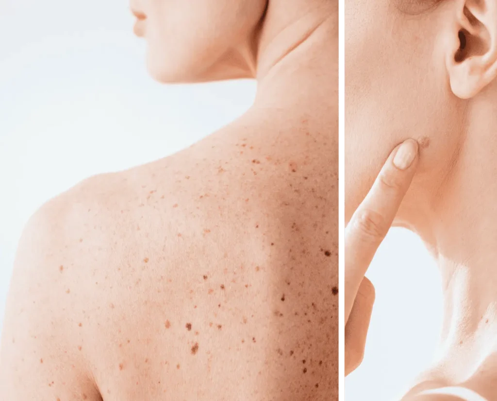 Trouver un dermatologue ? Plus difficile qu’un billet pour Katy Perry !