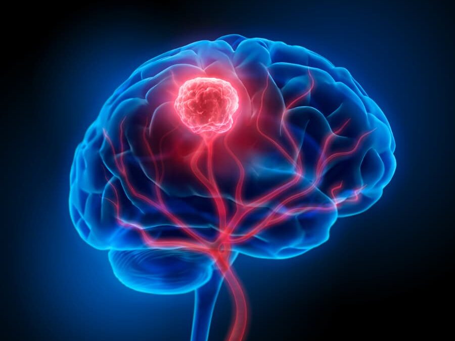 Cancer du cerveau : une maladie rare, mais redoutable