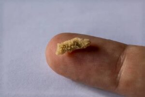 Des microbes cachés dans les calculs rénaux : une piste qui change la donne