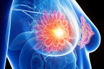 Cancer du sein après un accouchement : un risque accru de métastases (wikipedia commons)