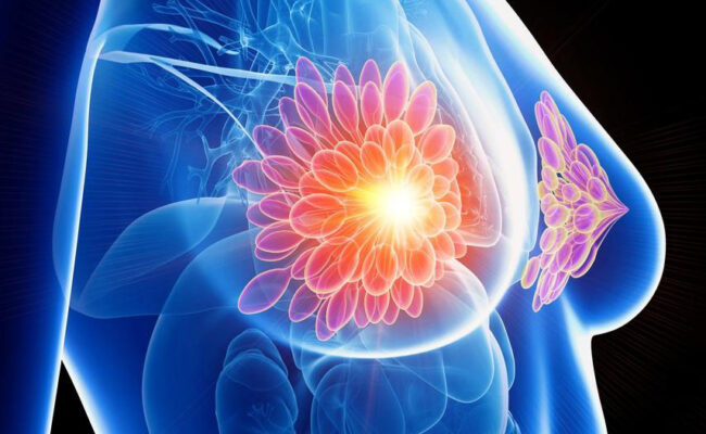 Cancer du sein après un accouchement : un risque accru de métastases (wikipedia commons)