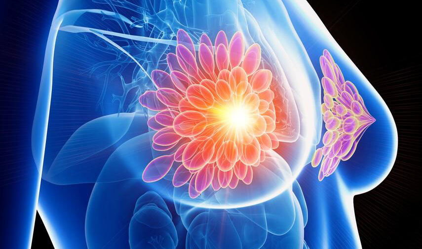 Cancer du sein après un accouchement : un risque accru de métastases (wikipedia commons)