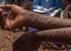 La Réunion face au Mpox : un premier cas importé déclenche le dispositif sanitaire