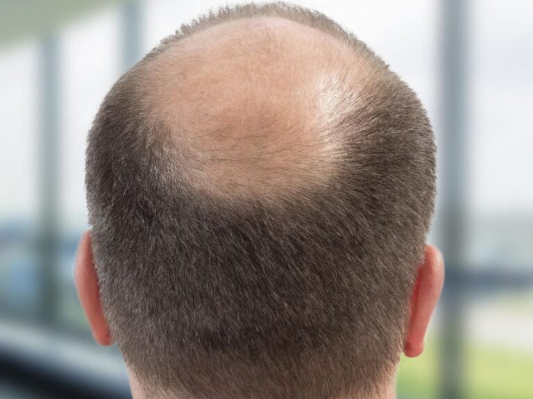 Calvitie : un traitement prometteur encore en phase d’évaluation