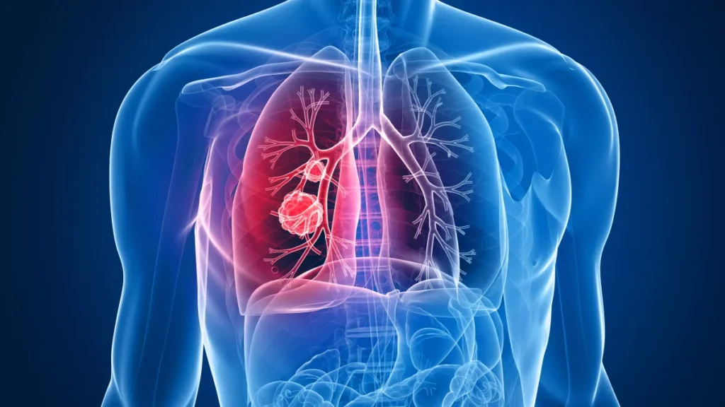 Cancer du poumon - vers un dépistage organisé aux bénéfices majeurs pour la santé publique