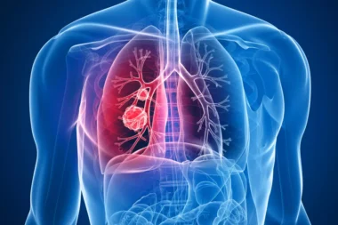 Cancer du poumon - vers un dépistage organisé aux bénéfices majeurs pour la santé publique