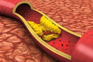 Cholestérol - deux nouvelles pilules rebattent les cartes face aux statines (AP)