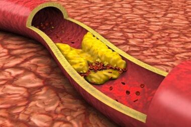 Cholestérol - deux nouvelles pilules rebattent les cartes face aux statines (AP)