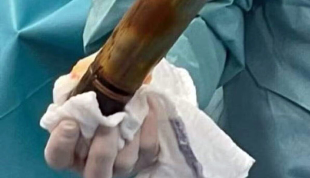 Insolite - À Toulouse, un homme hospitalisé avec un obus coincé dans l’anus. (DR)