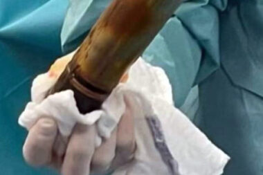 Insolite - À Toulouse, un homme hospitalisé avec un obus coincé dans l’anus