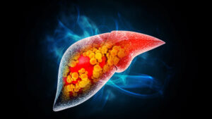 MASH - cette maladie silencieuse du foie concerne déjà un million de Français