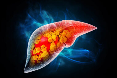 MASH - cette maladie silencieuse du foie concerne déjà un million de Français
