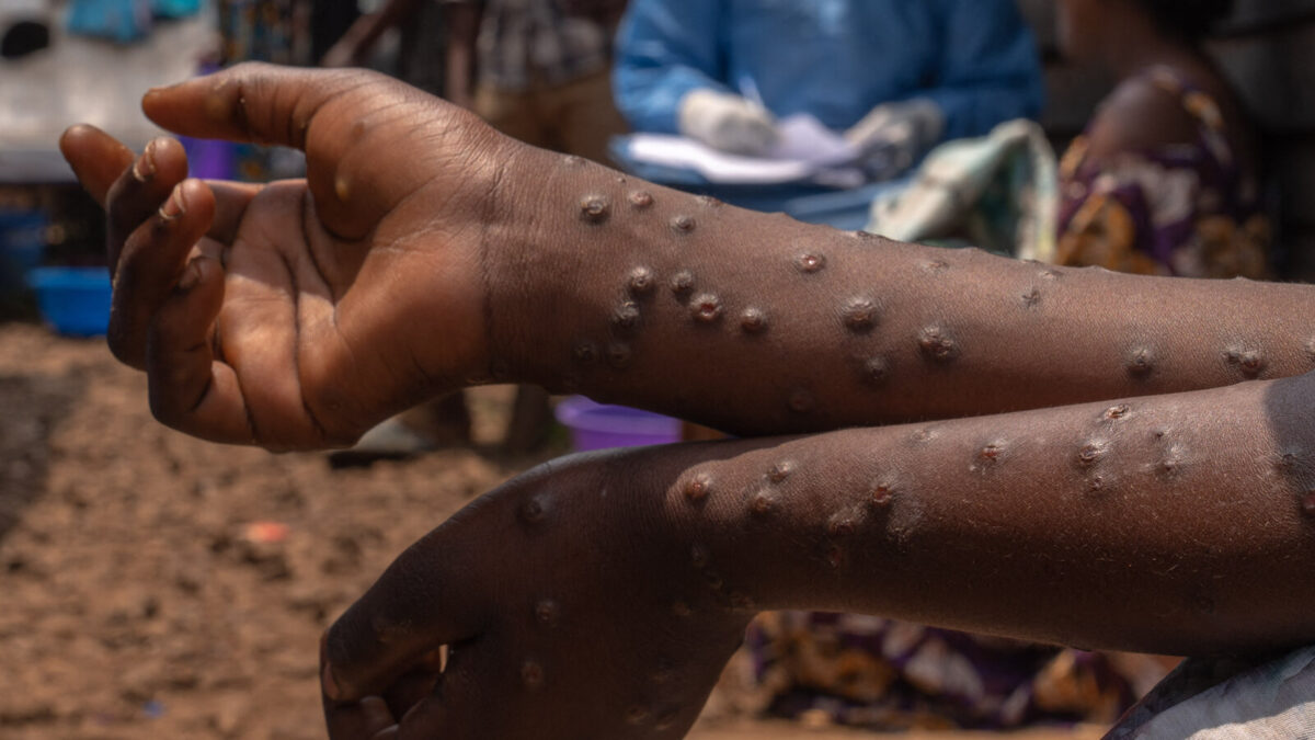 Mayotte - un pompier testé positif au Mpox, la caserne désinfectée par précaution