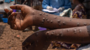 Mayotte - un pompier testé positif au Mpox, la caserne désinfectée par précaution